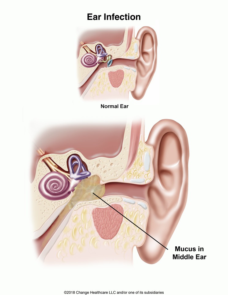 Ear Infection (Otitis Media): Illustration