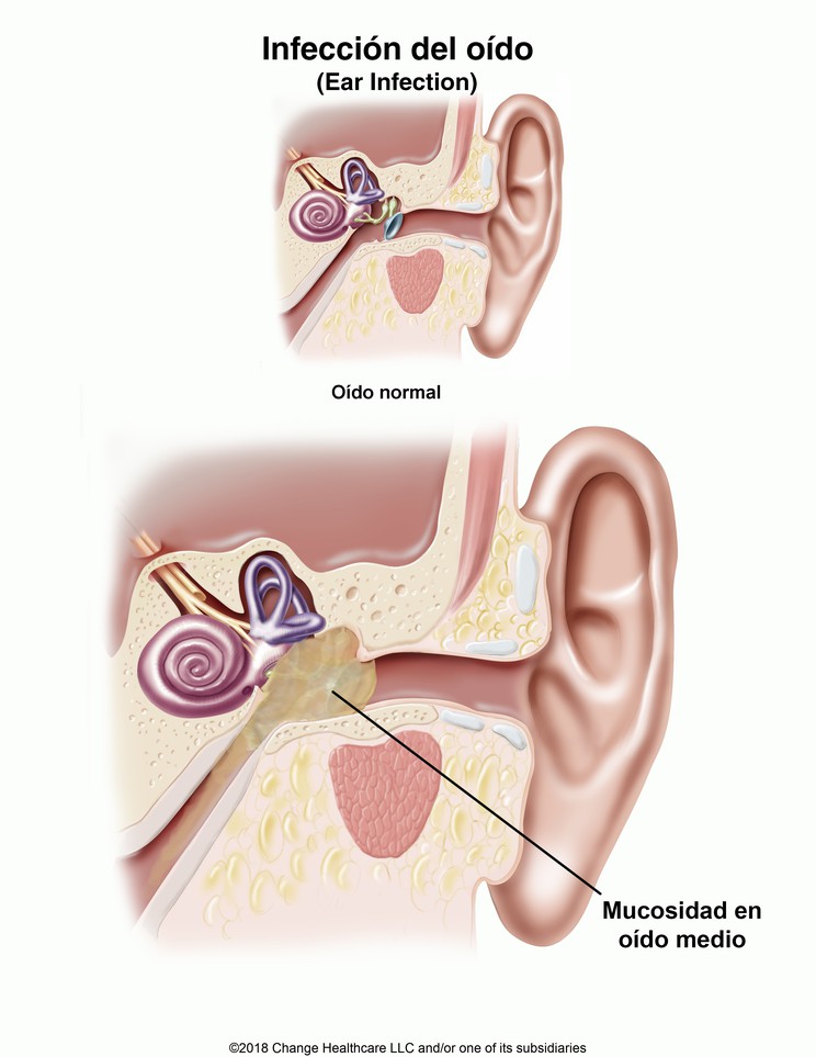 Ear Infection: Illustration