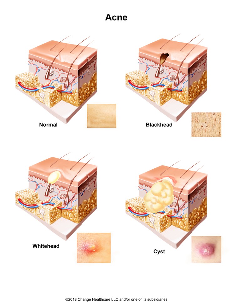 Acne: Illustration