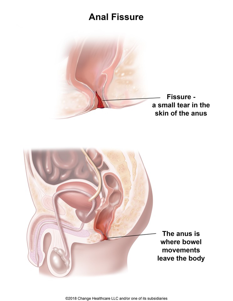 Anal Fissure: Illustration