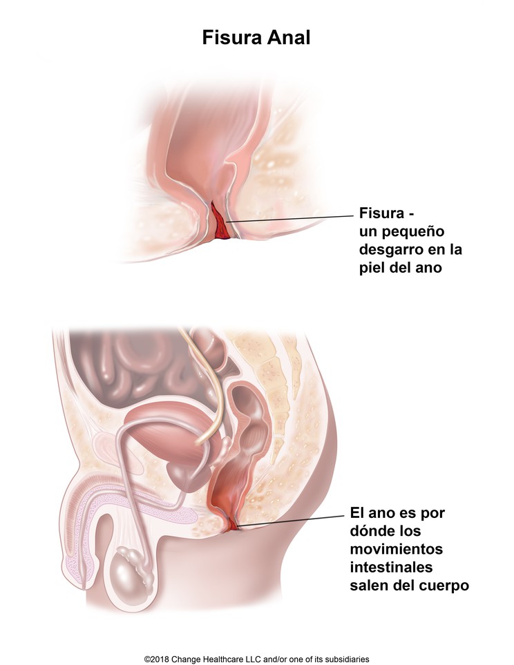 Anal Fissure: Illustration