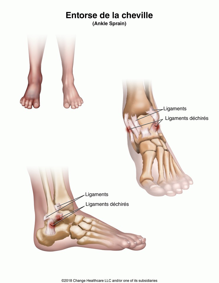 Ankle Sprain: Illustration