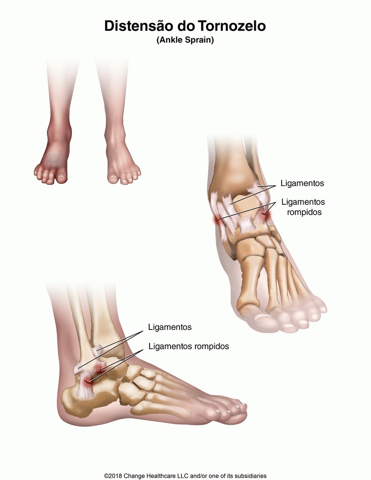 Ankle Sprain: Illustration