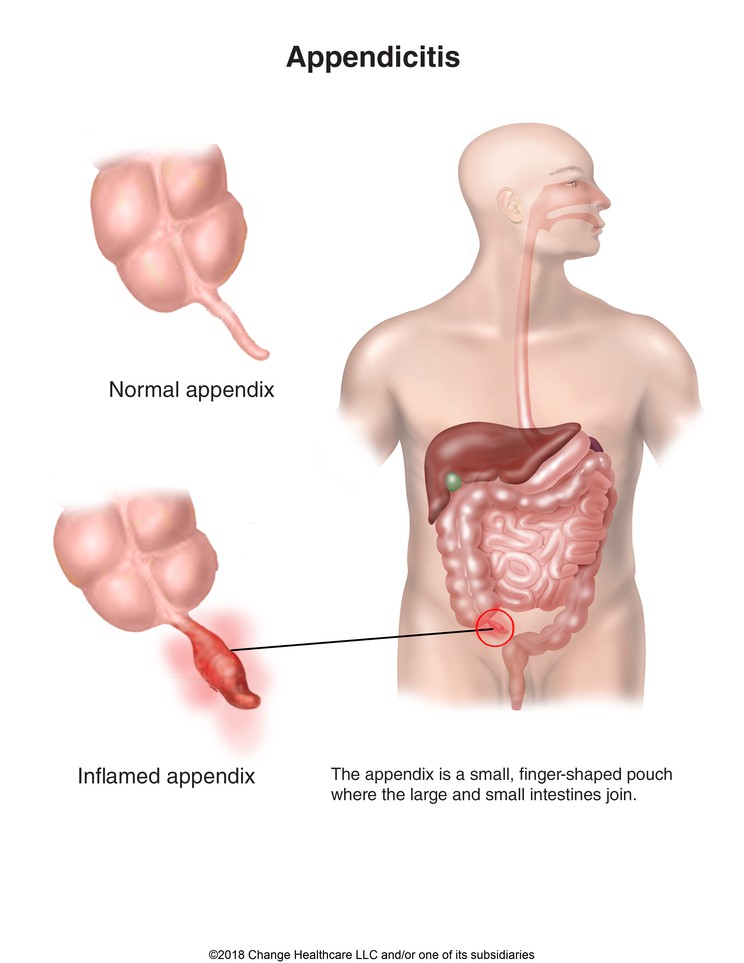 Appendicitis: Illustration