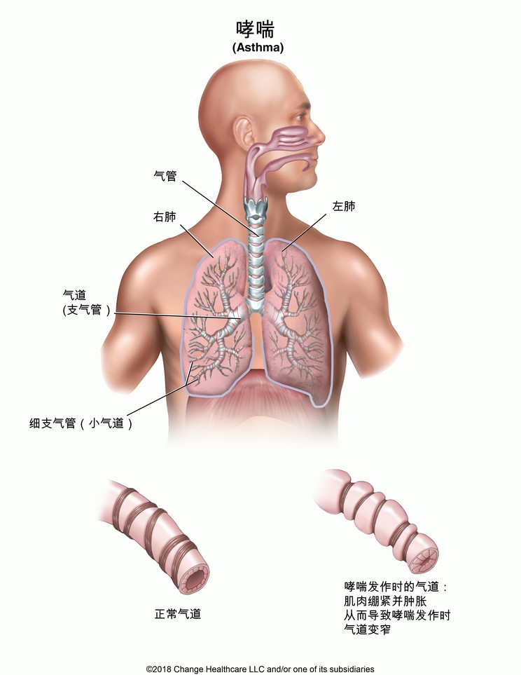 Asthma: Illustration