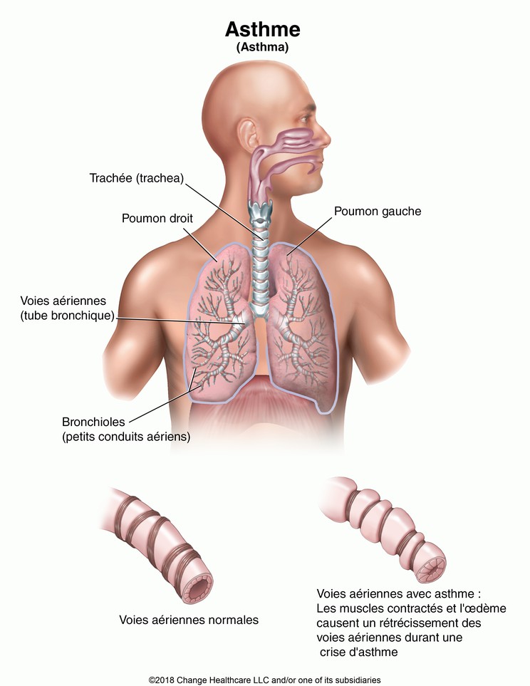 Asthma: Illustration