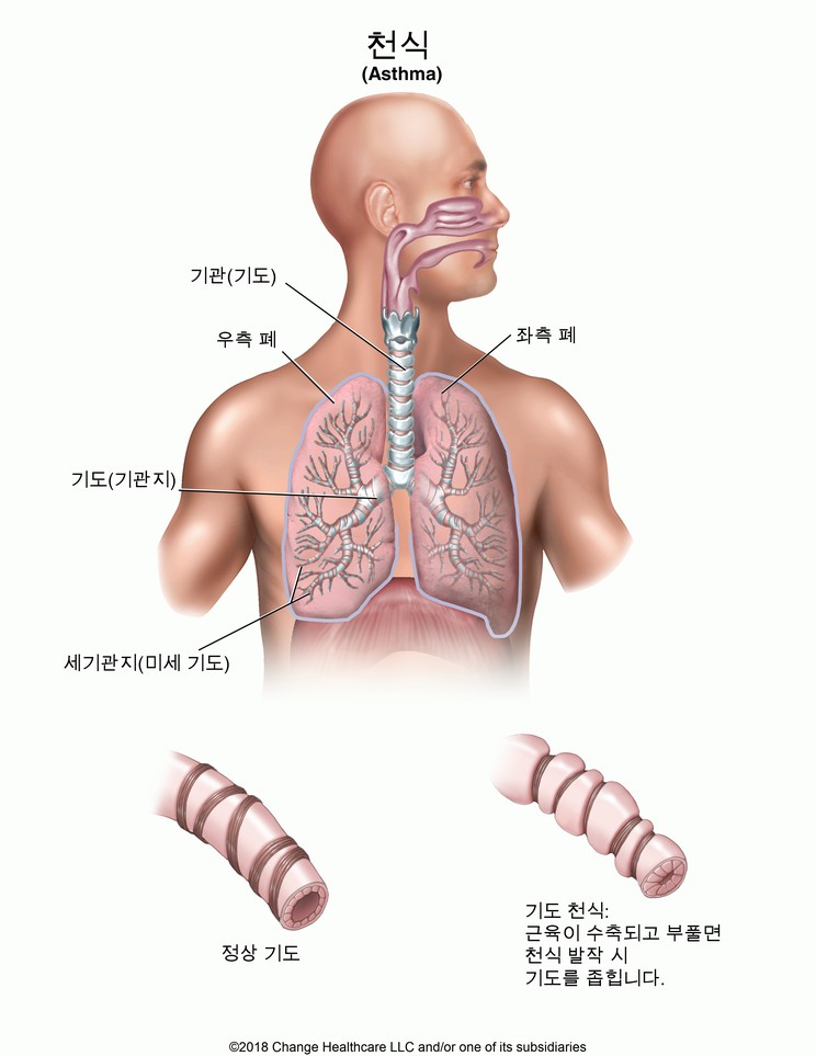 Asthma: Illustration