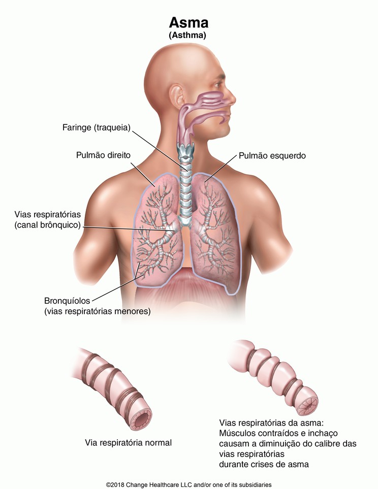Asthma: Illustration