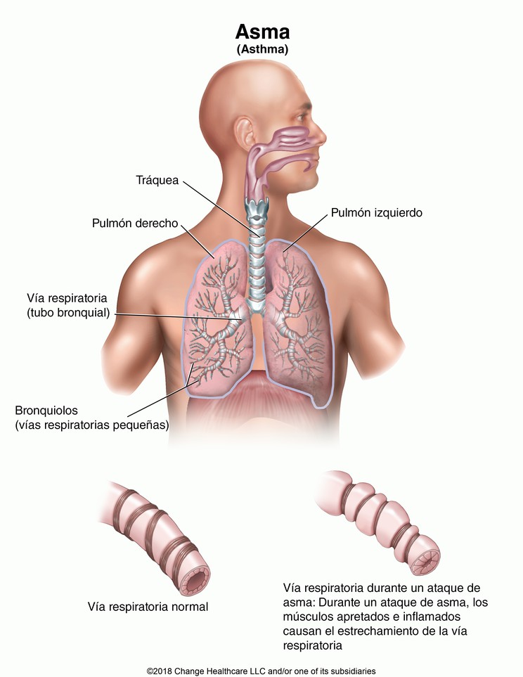 Asthma: Illustration