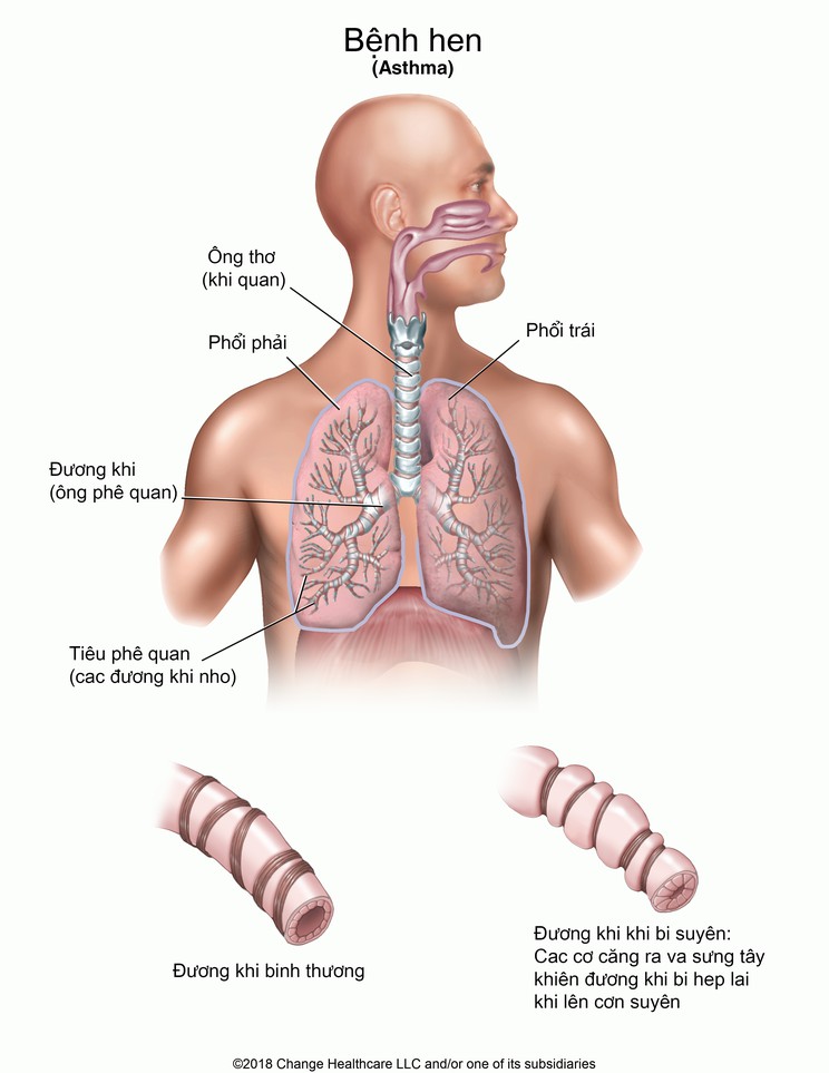 Asthma: Illustration