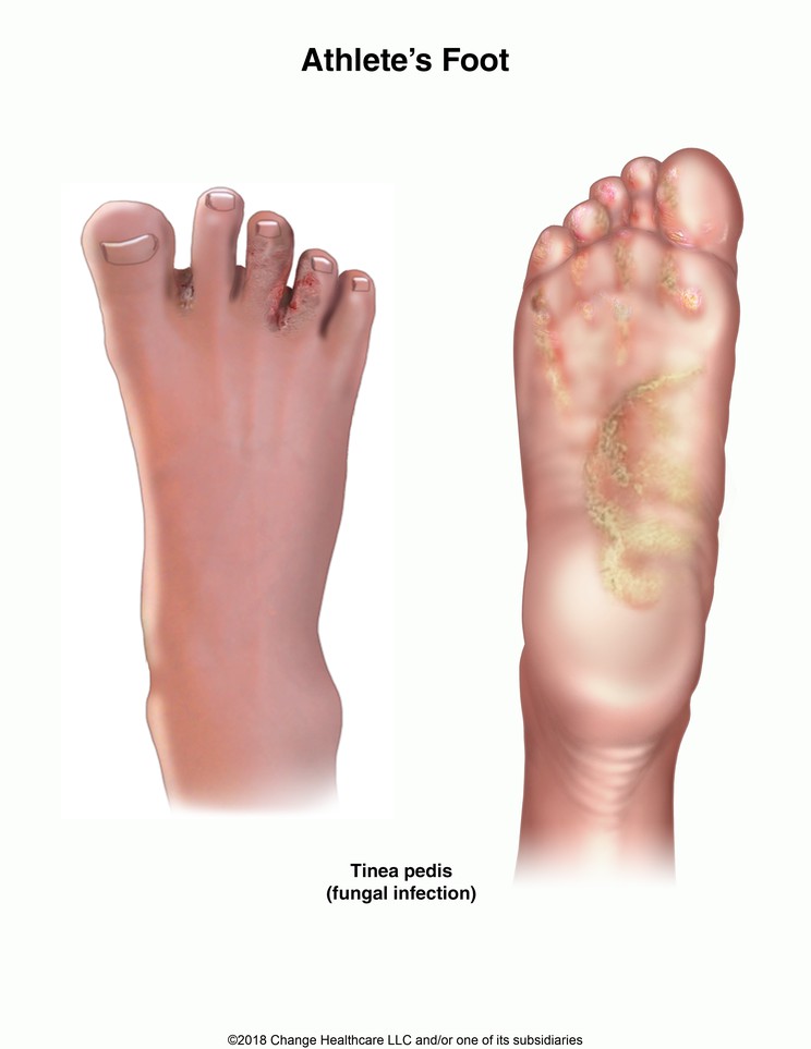 Athlete's Foot: Illustration