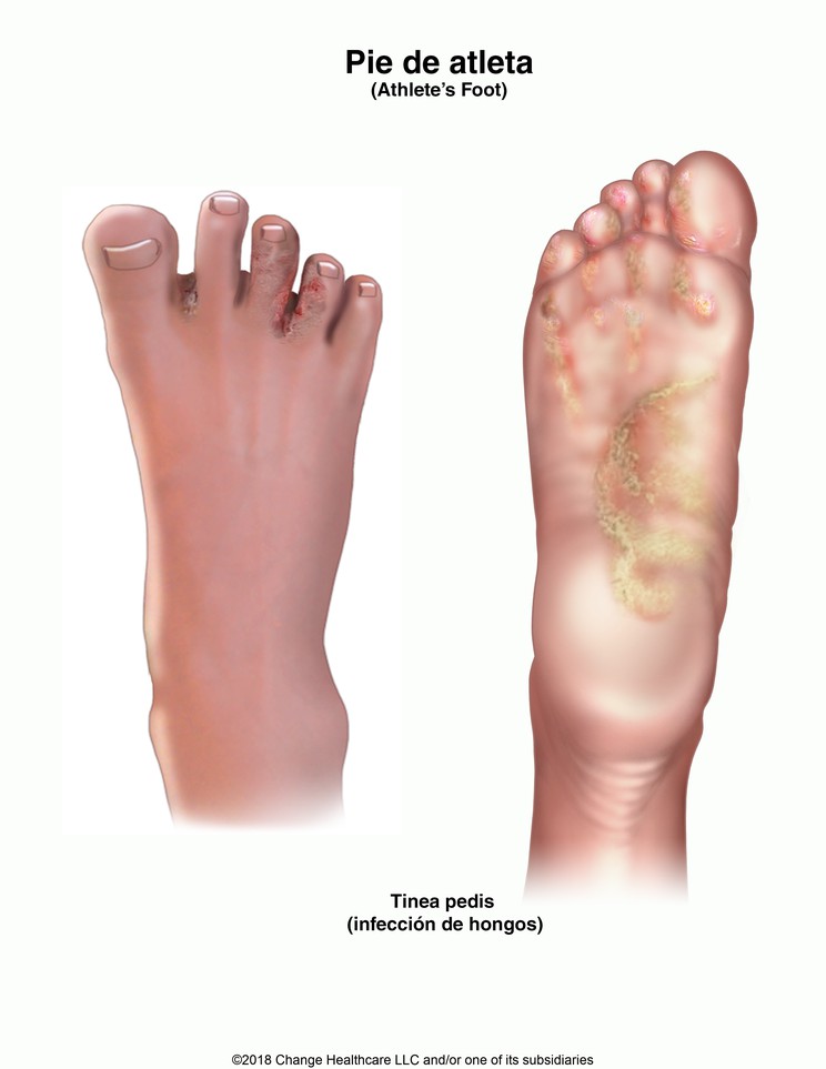 Athlete's Foot: Illustration