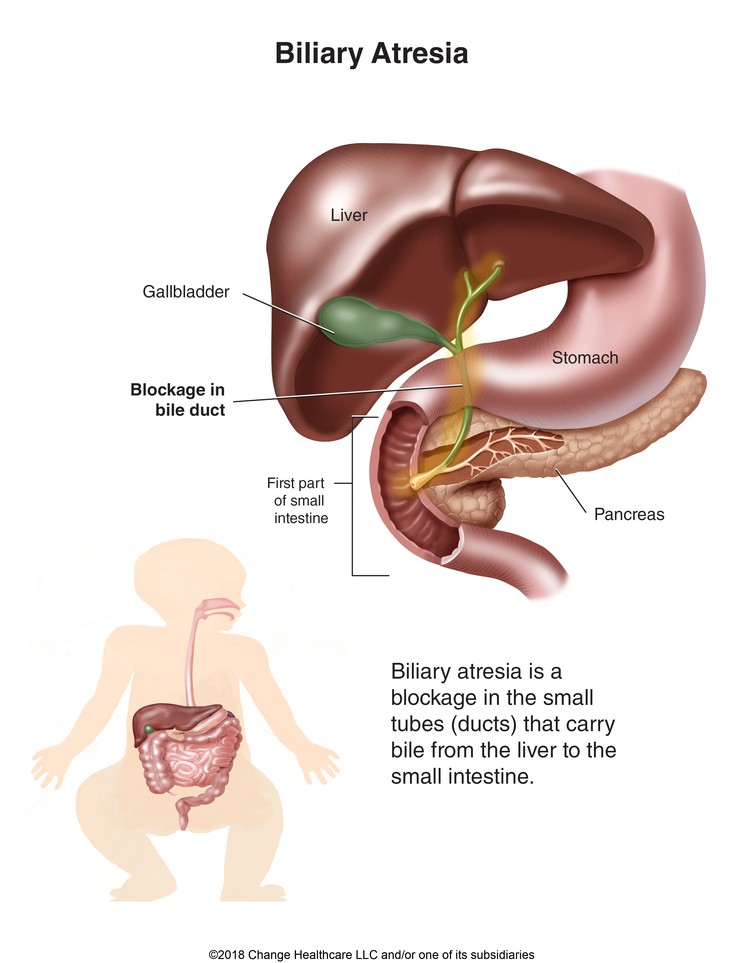 Biliary Atresia: Illustration