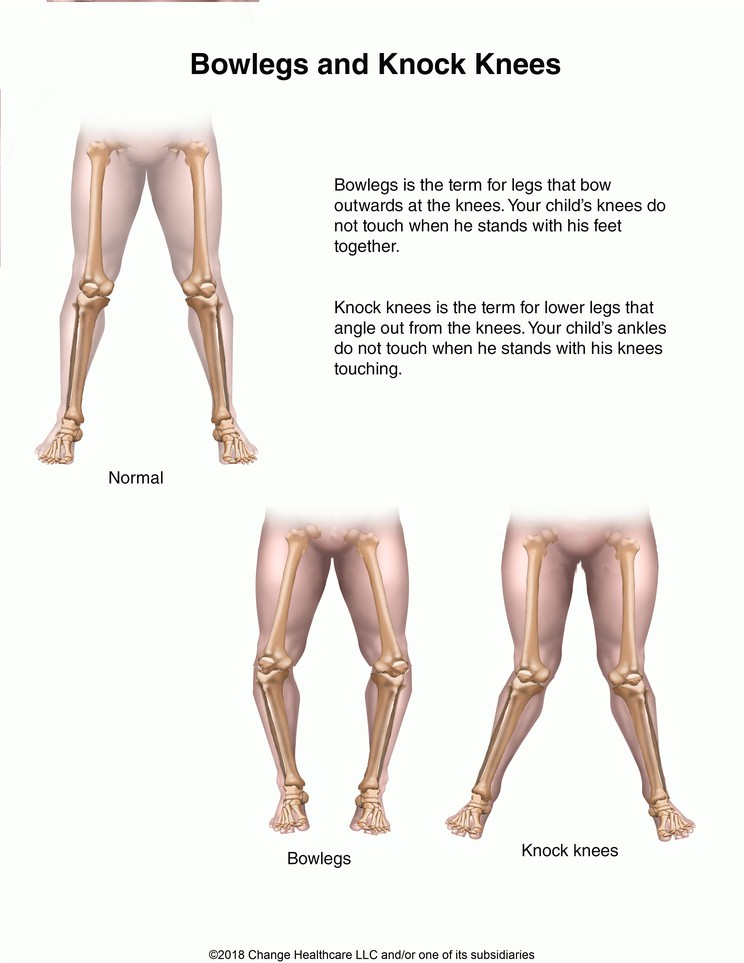 Bowlegs and Knock Knees: Illustration