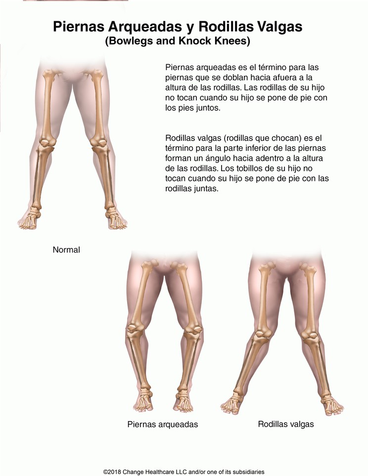 Bowlegs and Knock Knees: Illustration