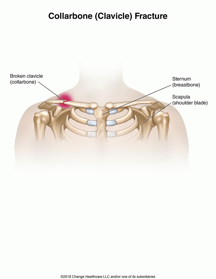 Collarbone (Clavicle) Fracture: Illustration