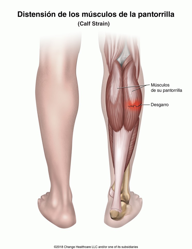 Calf Strain: Illustration