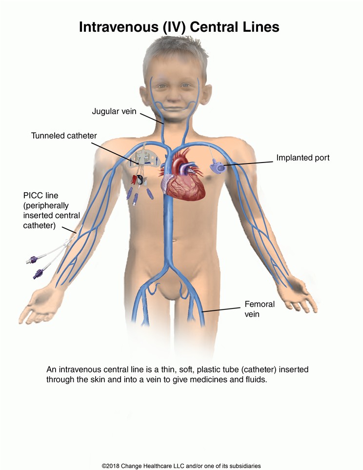 Intravenous (IV) Central Lines: Illustration