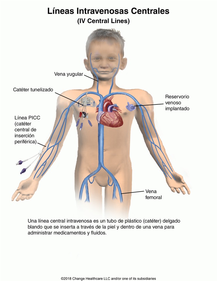 Intravenous (IV) Central Lines: Illustration