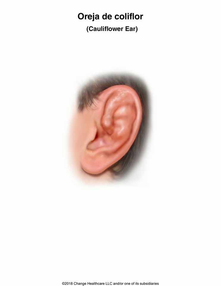 Cauliflower Ear: Illustration