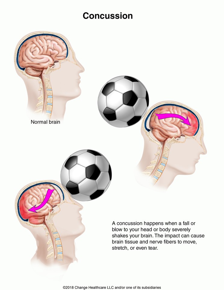 Concussion: Illustration