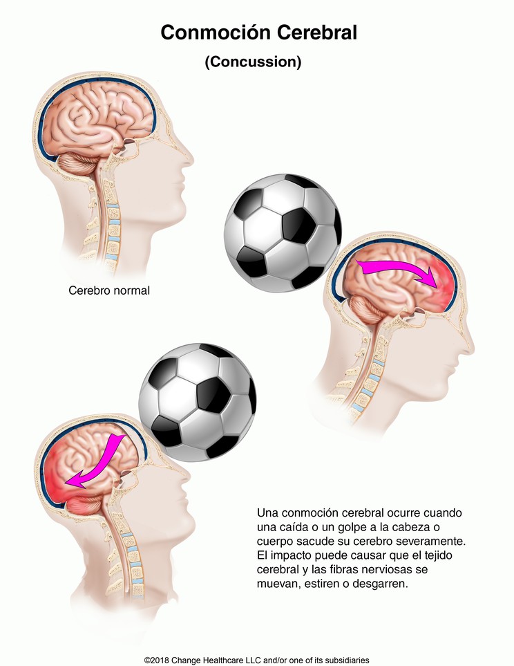 Concussion: Illustration