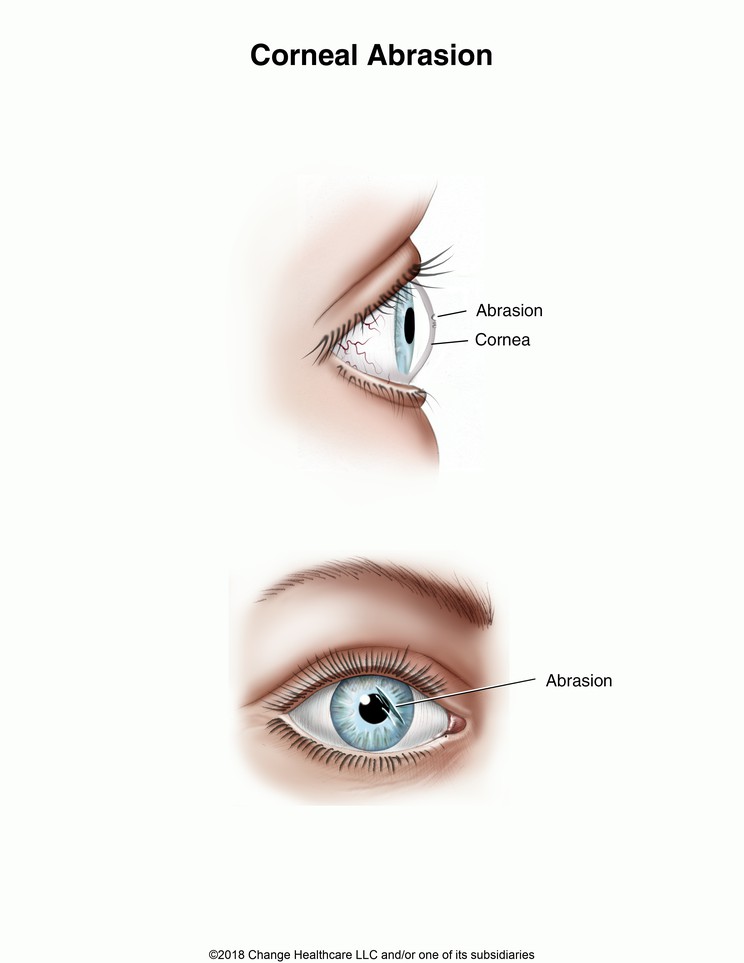 Corneal Abrasion: Illustration