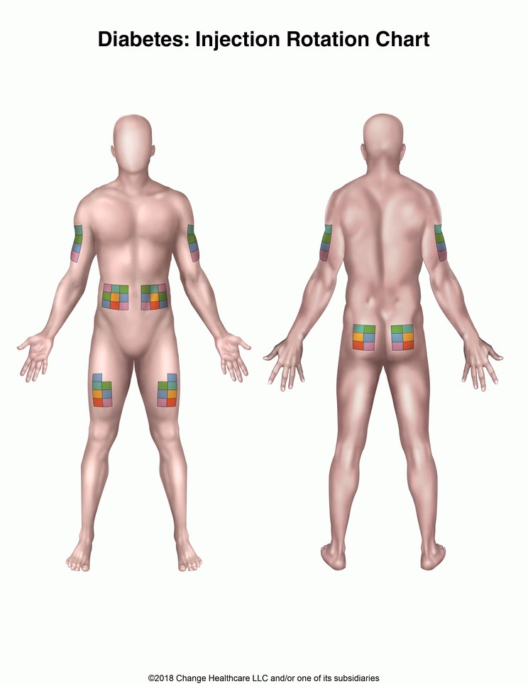 Diabetes: Injection Rotation Chart: Illustration