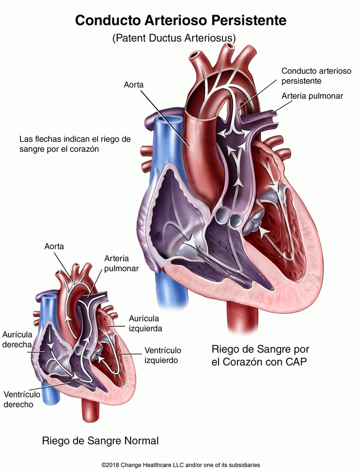 Patent Ductus Arteriosus: Illustration