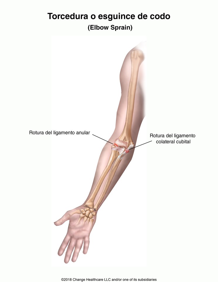 Elbow Sprain: Illustration