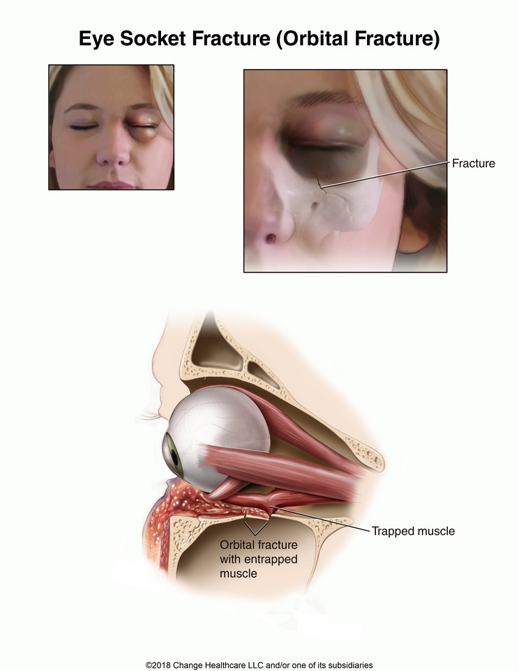 Eye Socket Fracture: Illustration