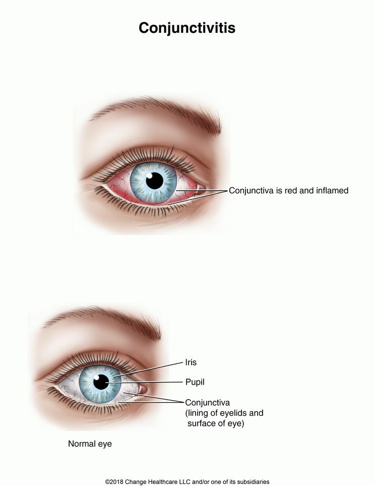 Conjunctivitis: Illustration