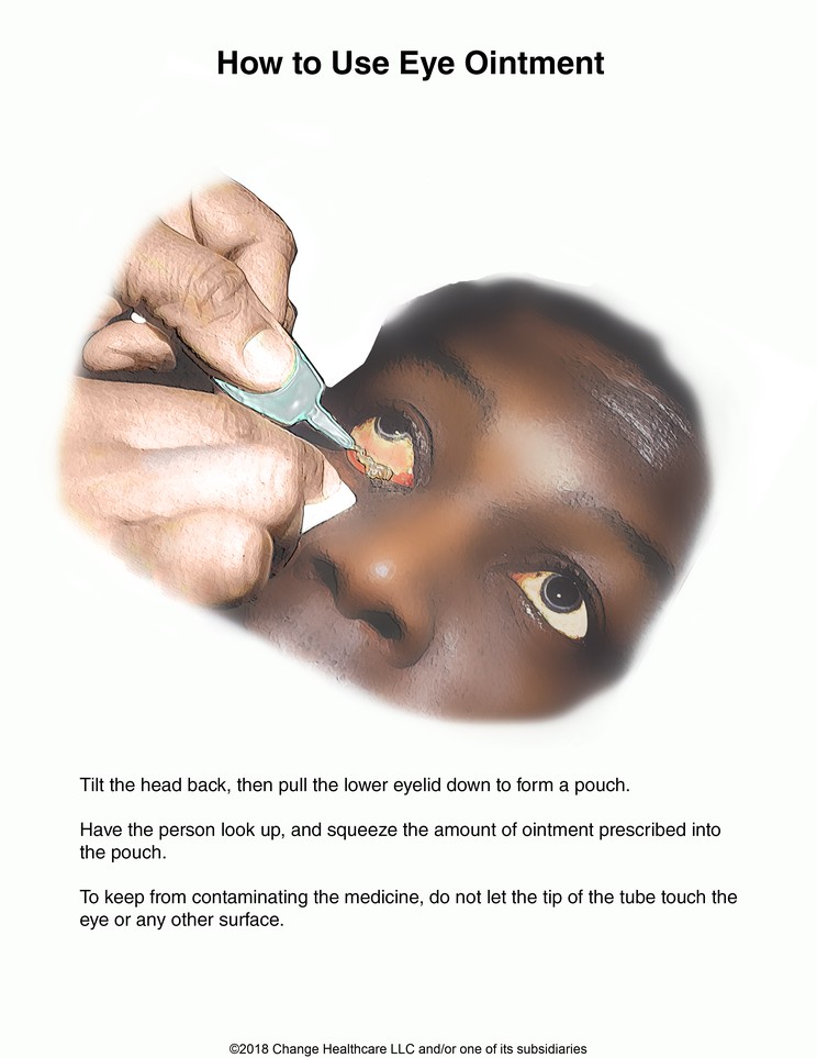 How to Use Eye Ointment: Illustration