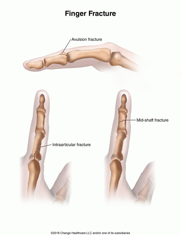 Finger Fracture: Illustration