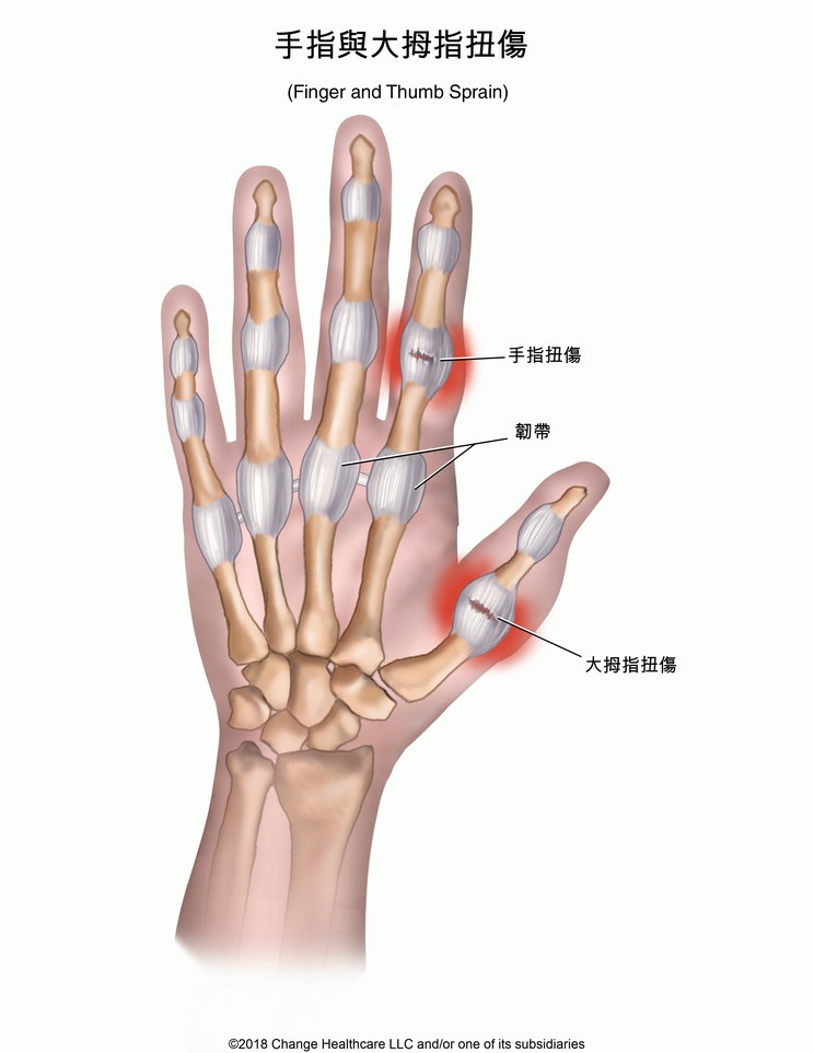 Finger and Thumb Sprain: Illustration