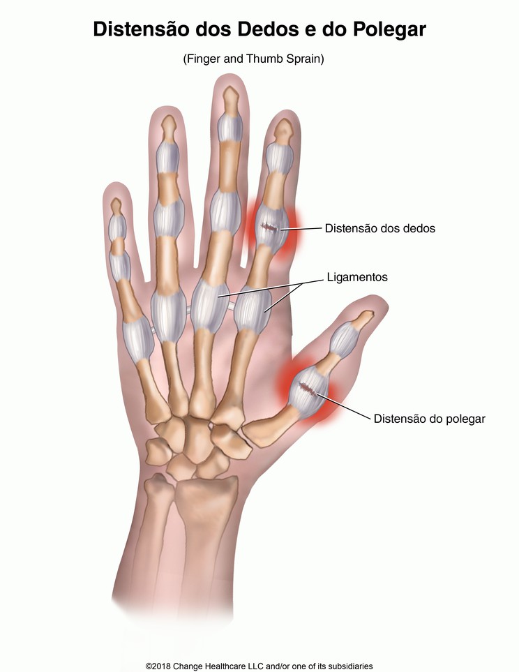 Finger and Thumb Sprain: Illustration