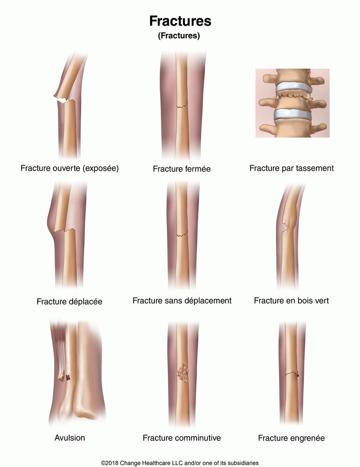 Fractures: Illustration