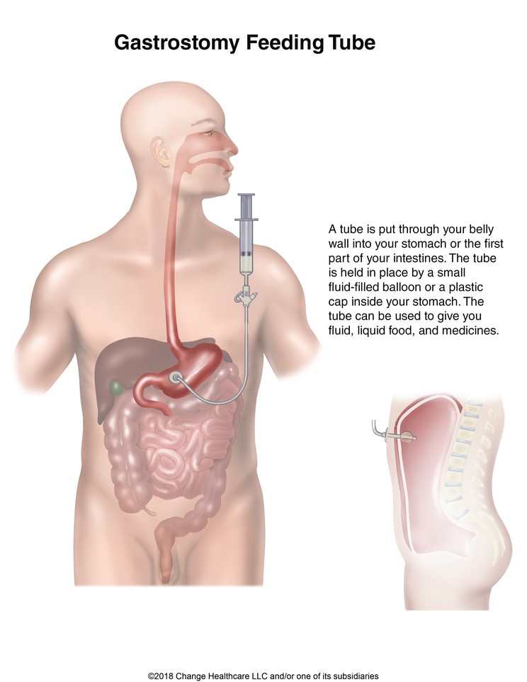 Gastrostomy Feeding Tube: Illustration