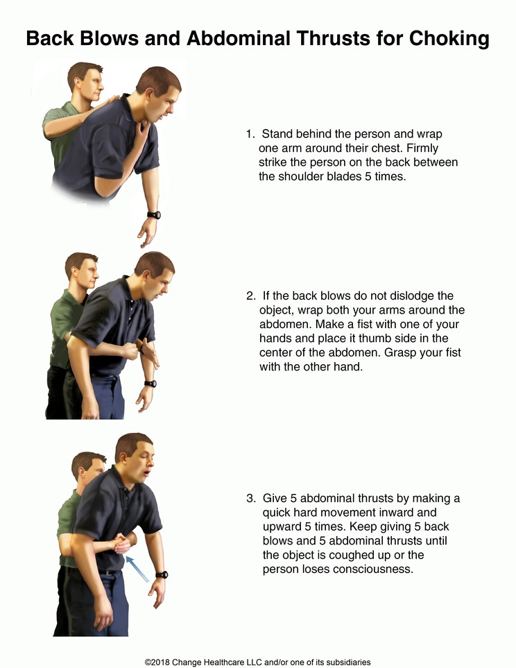 Back Blows and Abdominal Thrusts for Choking: Illustration
