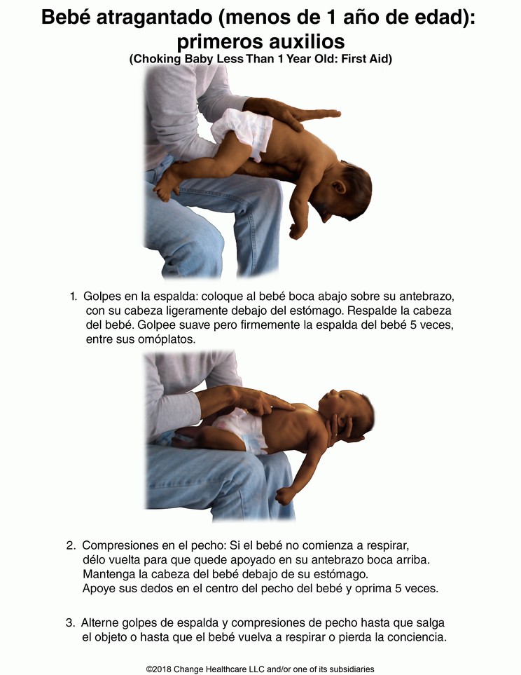 Choking Baby (Less Than 1 year Old): First Aid: Illustration