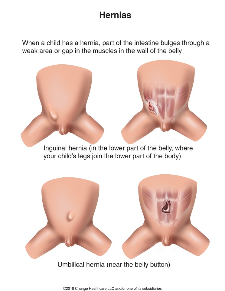 Hernia: Illustration