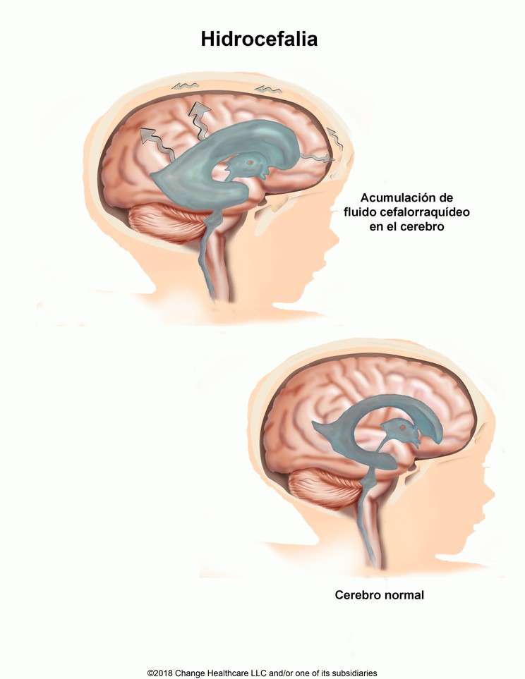 Hydrocephalus: Illustration