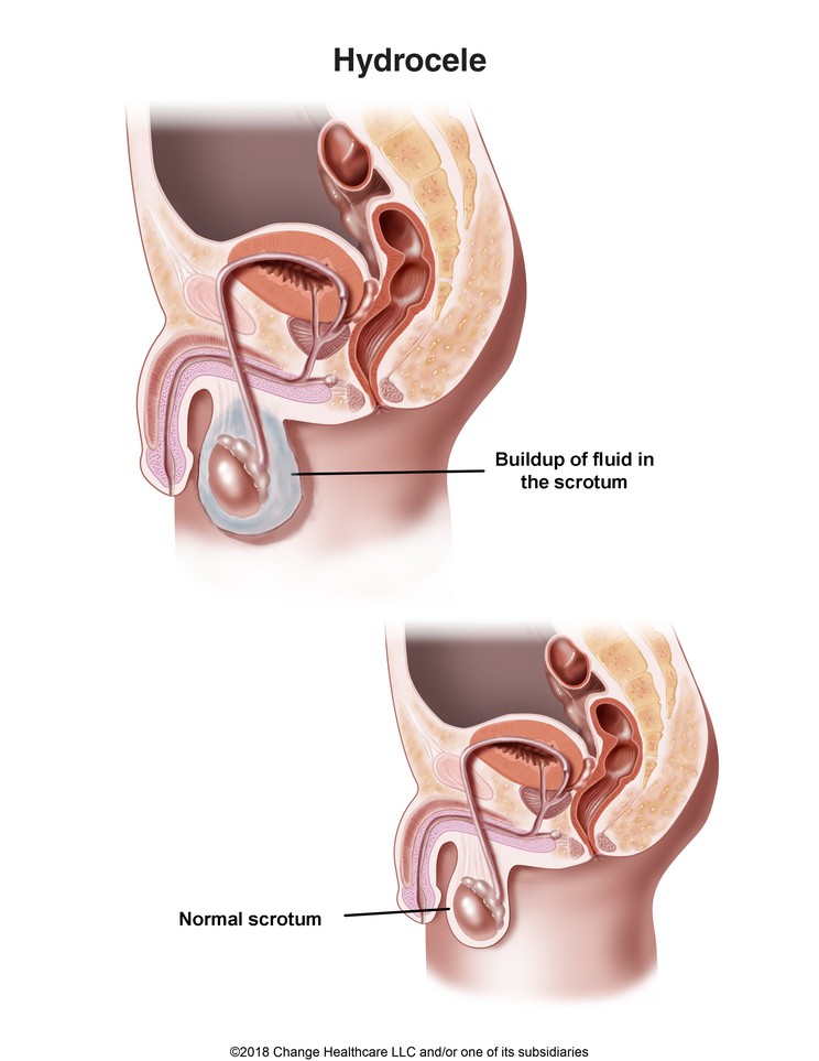 Hydrocele: Illustration