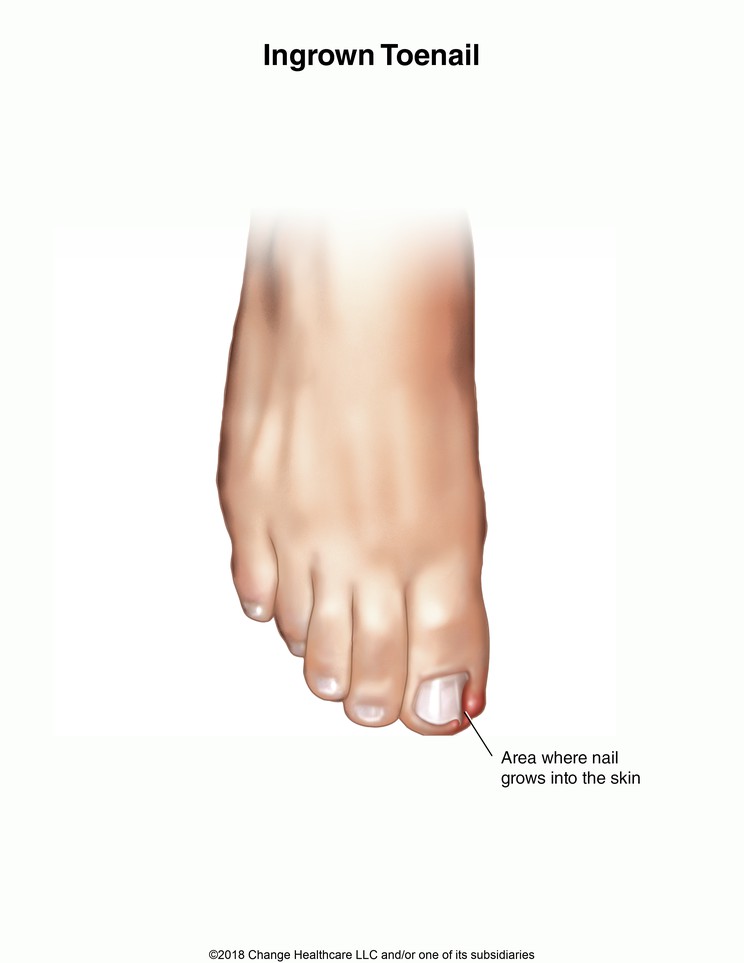 Ingrown Toenail: Illustration