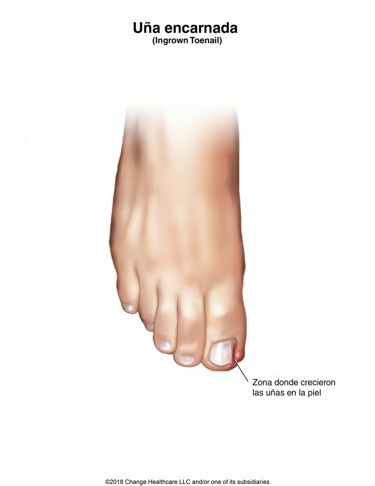 Ingrown Toenail: Illustration