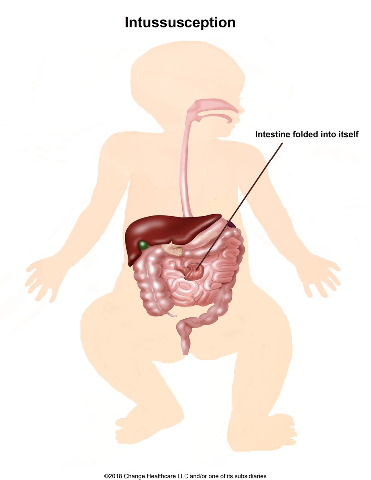 Intussusception: Illustration