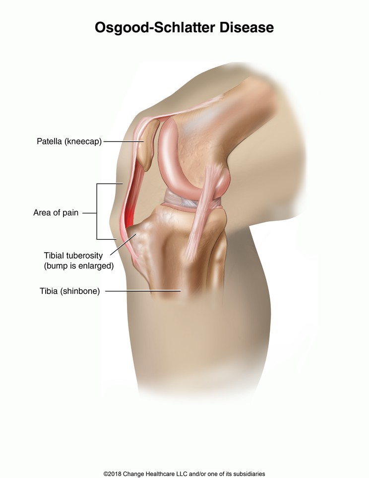 Osgood-Schlatter Disease: Illustration