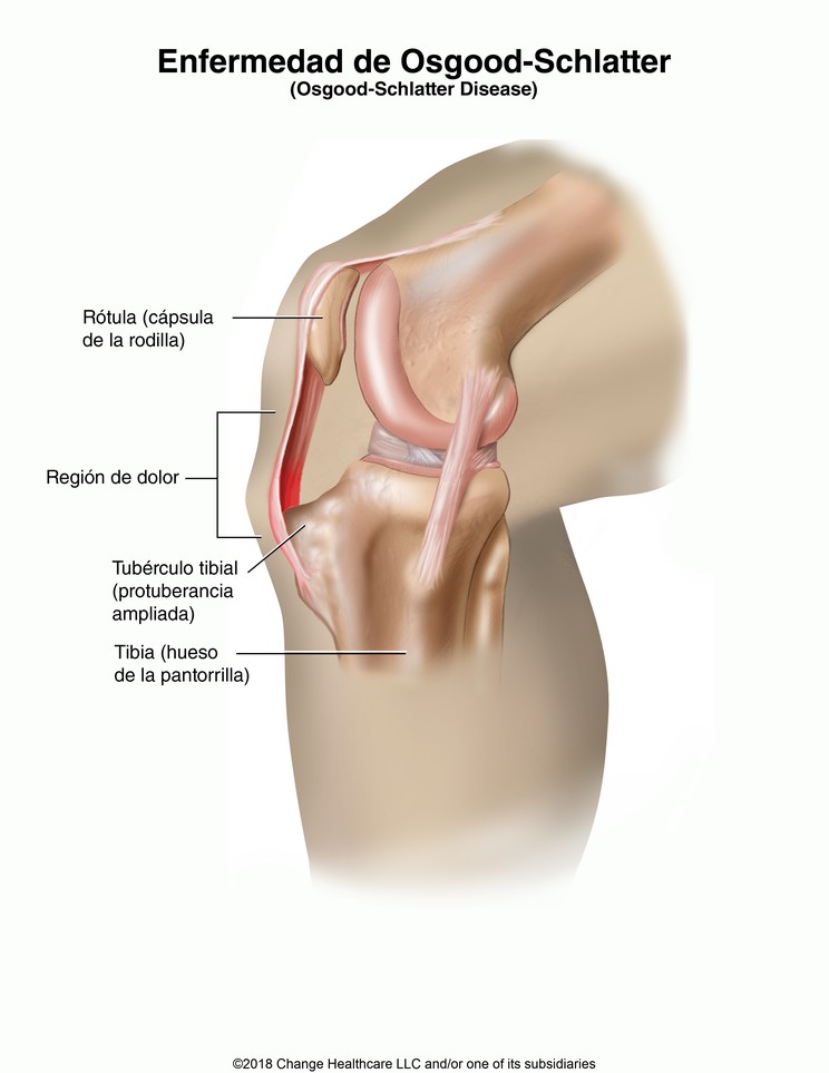 Osgood-Schlatter Disease: Illustration