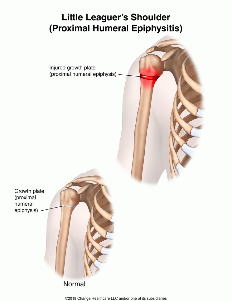 Little Leaguer's Shoulder (Proximal Humeral Epiphysitis): Illustration