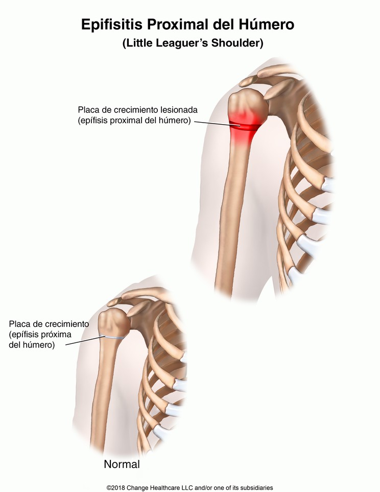 Little Leaguer's Shoulder (Proximal Humeral Epiphysitis): Illustration